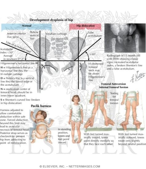 Pediatric Disorders of the Thigh and Hip