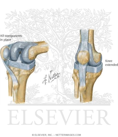 Total Knee Arthroplasty