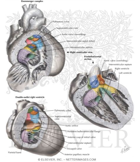 Anomalies of the Right Ventricular - Outflow Tract