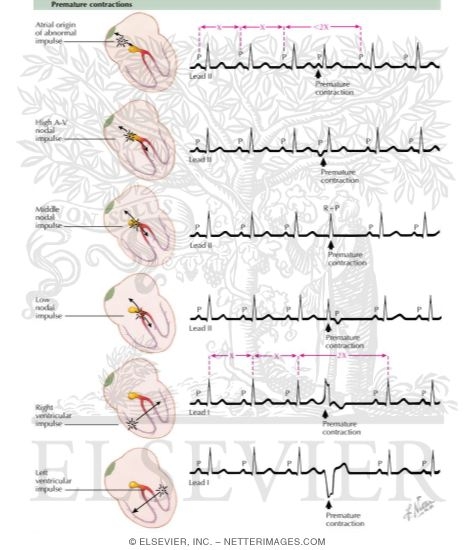 Premature Contractions
