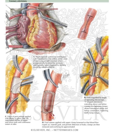 Patch-Graft Reconstruction