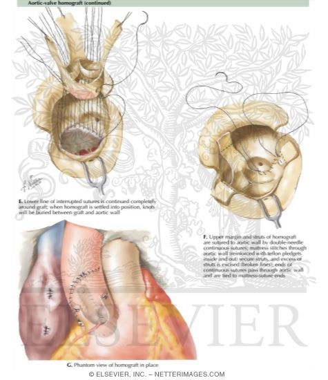 Aortic-Valve Homograft