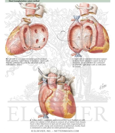 HEART TRANSPLANTation - Suture Method - Netter Medical Artwork