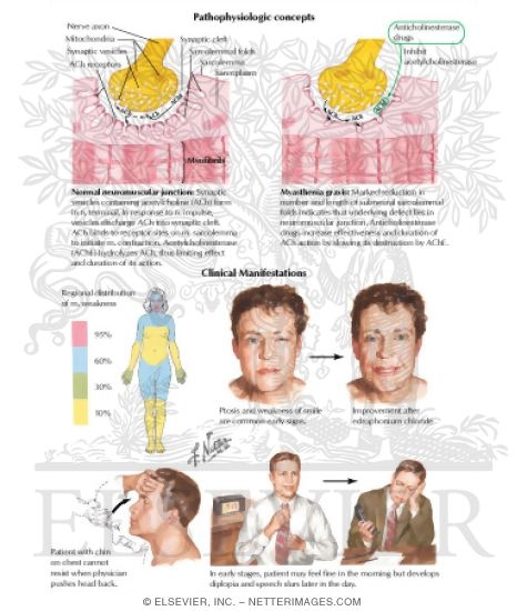 Example of Cholinergic Drug Treatment: Myasthenia Gravis