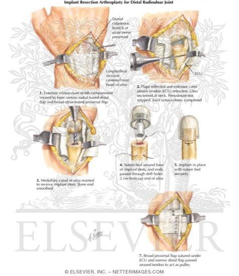Distal Radioulnar
