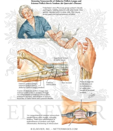 flexor pollicis longus. Abductor Pollicis Longus