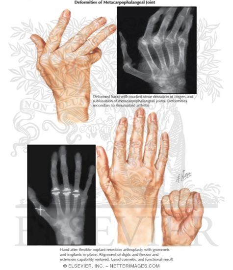 Implant Resection Arthroplasty for Metacarpophalangeal Joints (Continued)