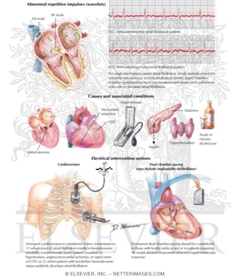 Atrial Fibrillation