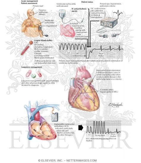 Ventricular Tachycardia