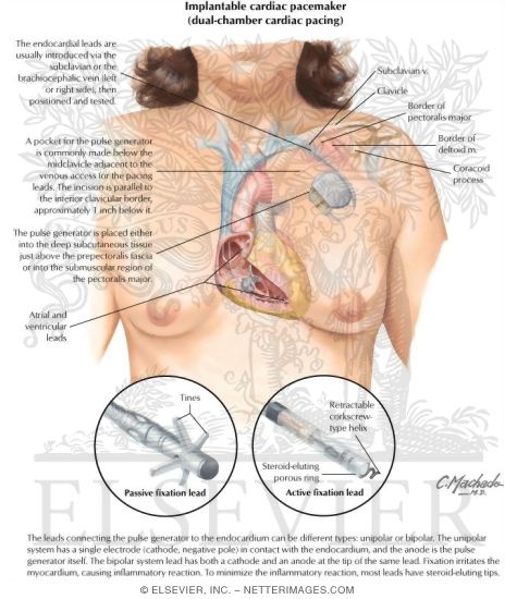 Cardiac Pacemakers