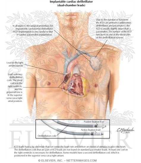 Implantable Cardiac Defibrillator (Dual-Chamber Leads)