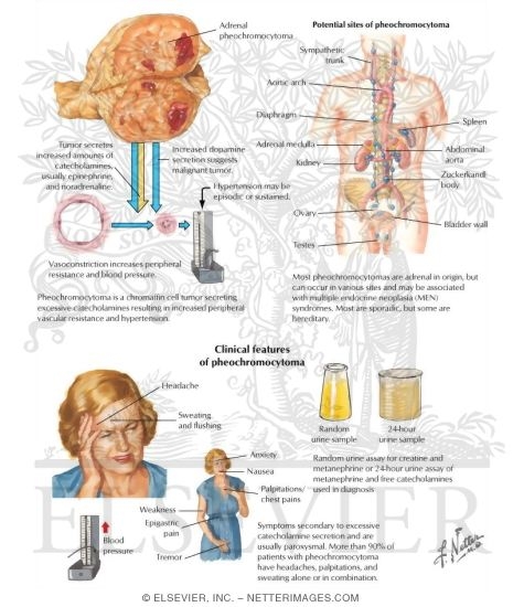 Pheochromocytoma