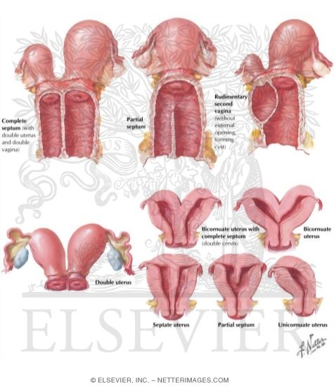 Paramesonephric Duct Anomalies