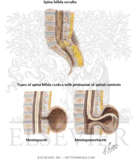 Spina Bifida