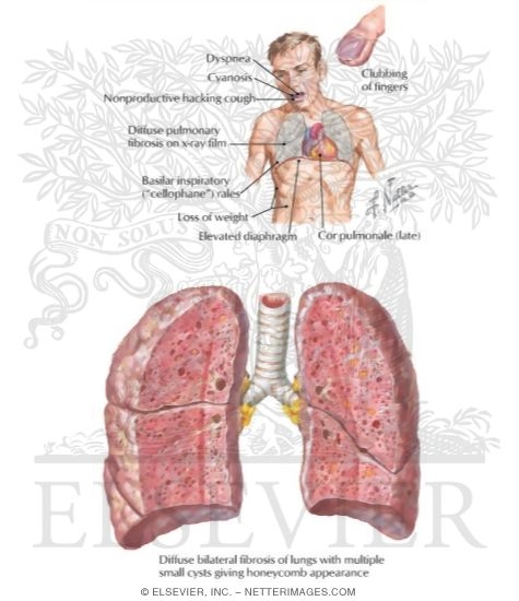Idiopathic Diffuse Interstitial Pulmonary Fibrosis (Hamman-Rich Disease)