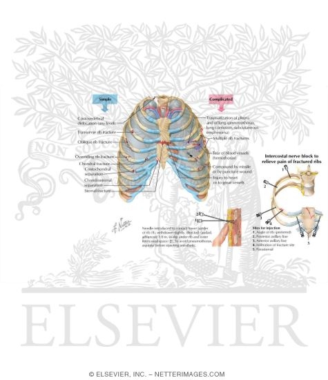 Thoracic Cage Injuries