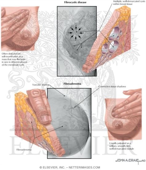 Fibrocystic Disease 
