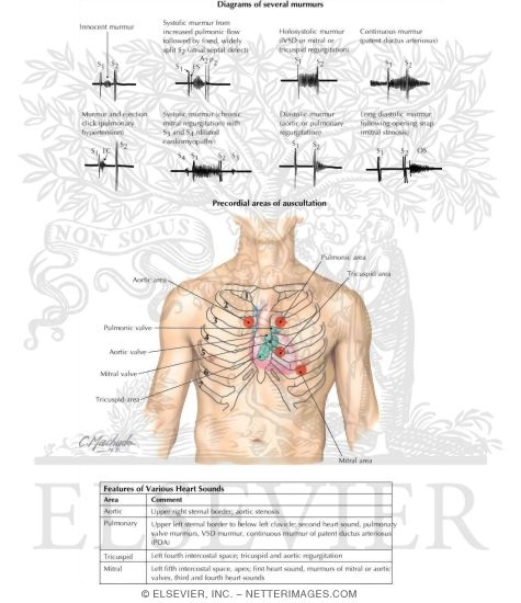 Cardiac Auscultation: Precordial Areas of Auscultation