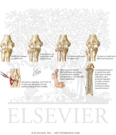 Fracture of the Radial Head and Neck