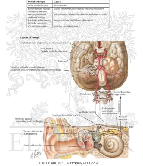 The Many Pathologic Causes of Vertigo