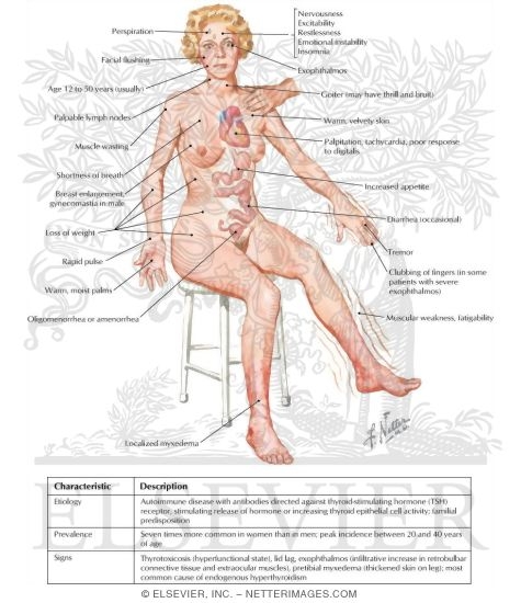 Hyperthyroidism With Diffuse Goiter (Graves' Disease)