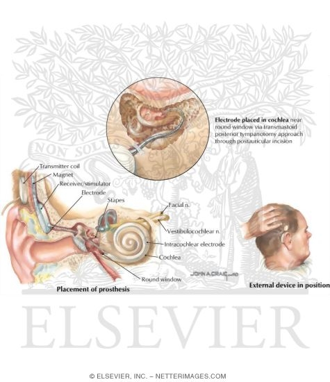 Cochlear Implant
