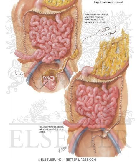 Surgical Treatment of Chronic Ulcerative Colitis: Stage II, Colectomy