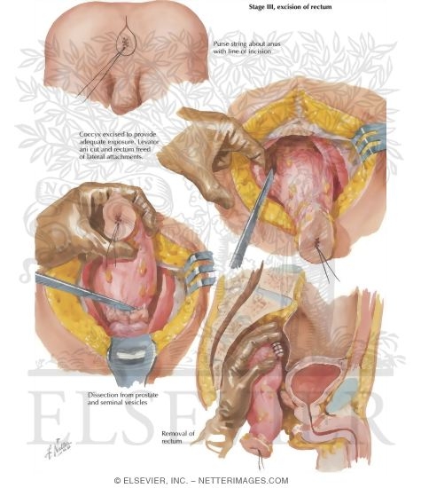 Surgical Treatment of Chronic Ulcerative Colitis: Stage III, Excision of Rectum