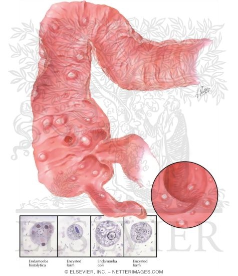 Amebic Colitis