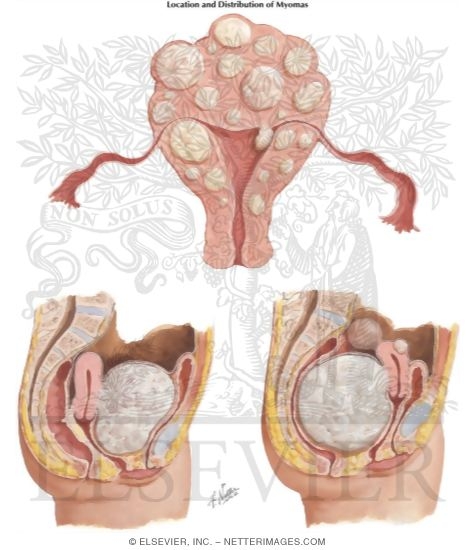 Myomectomy In Treatment of Infertility