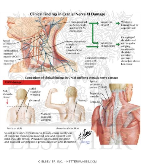 Nerve Lesions