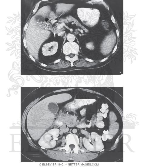 Acute Pancreatitis: CT Images of Mild and Moderately Severe Disease