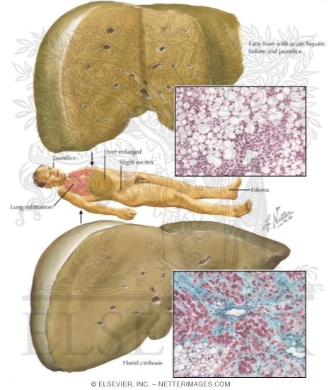 Nutritional Liver Diseases
