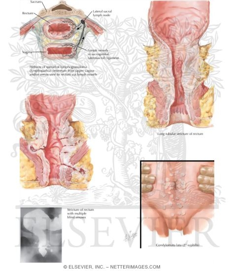 Proctologic Conditions V - Lymphogranuloma Venereum and Syphilis