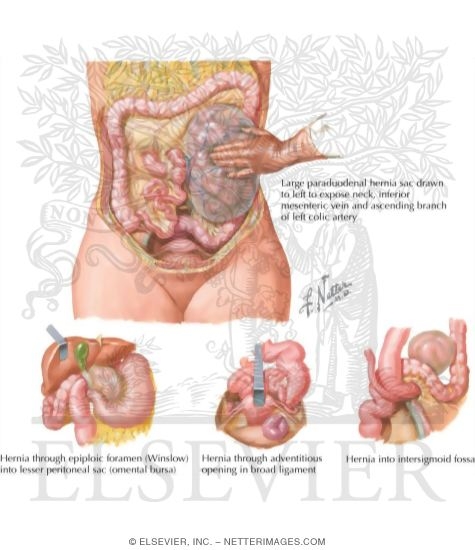 Internal Hernias: Congenital Intraperitoneal Hernias