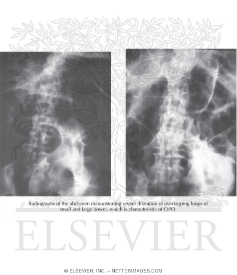 Chronic Intestinal Pseudo-Obstruction