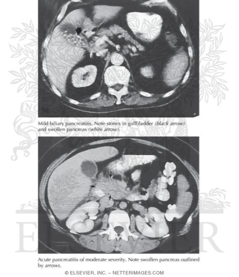 Acute Pancreatitis: CT Images of Mild and Moderately Severe Disease