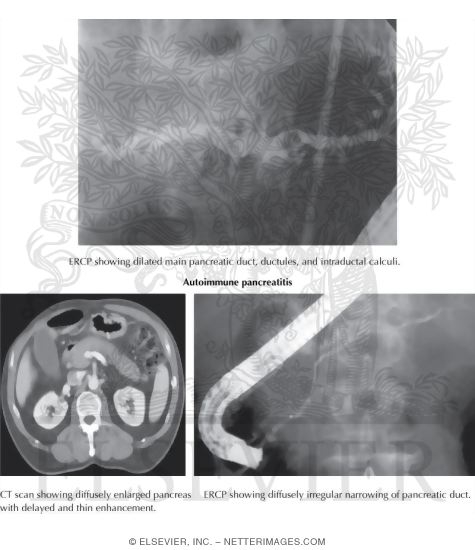 Chronic and Autoimmune Pancreatitis