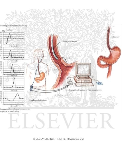 Esophageal Tests
