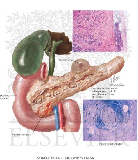 Chronic Pancreatitis