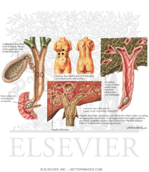 common bile duct size. hot of the common bile duct