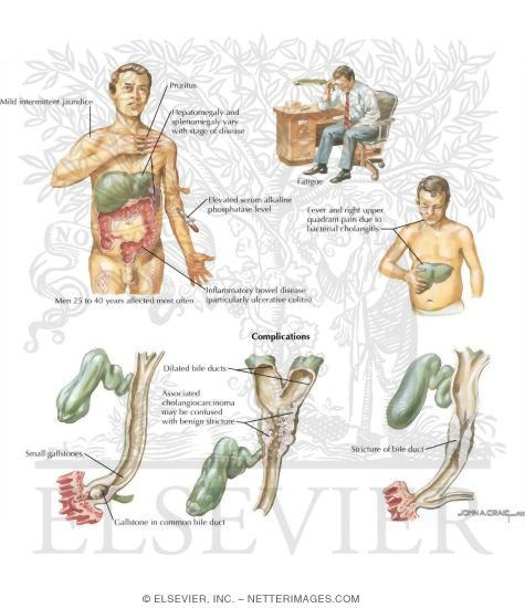 Sclerosing Cholangitis