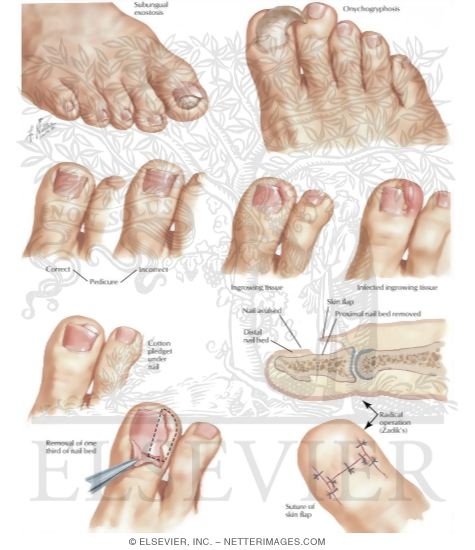 Disorders of Nails