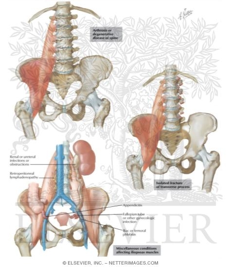 Arthrosis of the Spine