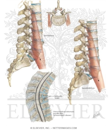 Spondylolysis