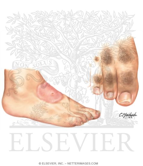 Noninfectious Cutaneous Manifestations In the Lower Extremity