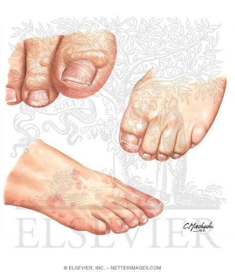 Noninfectious Cutaneous Manifestations In the Lower Extremity