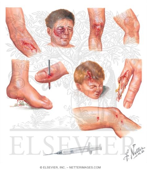Open Soft Tissue Wounds
