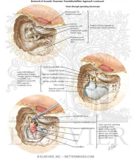 Translabyrinthine Removal of Acoustic Neuroma