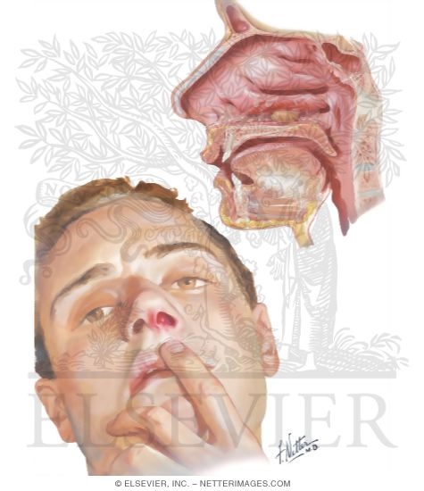 Foreign Body And Furunculosis